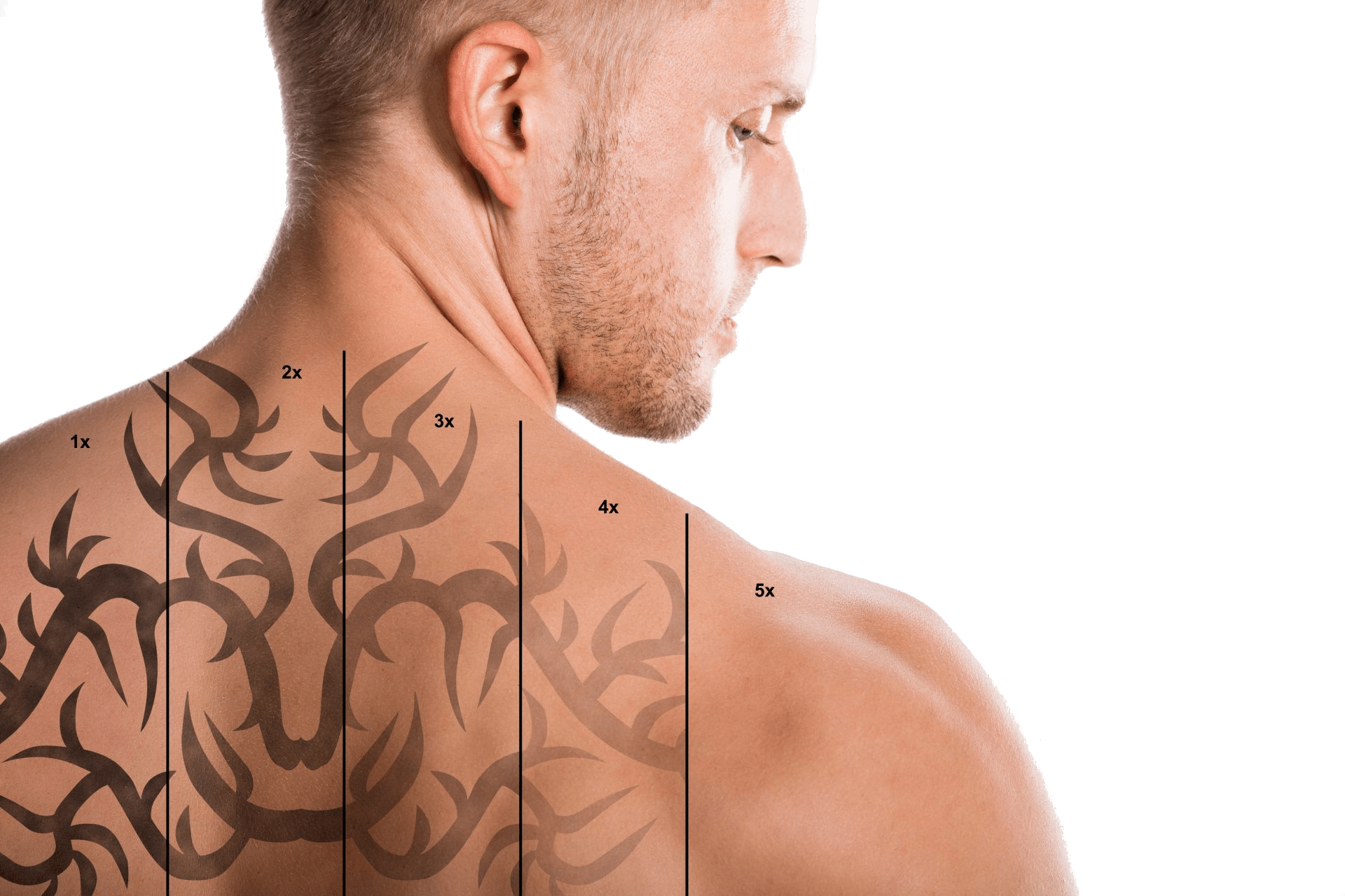 Tattoo removal using medical lasers in Prague